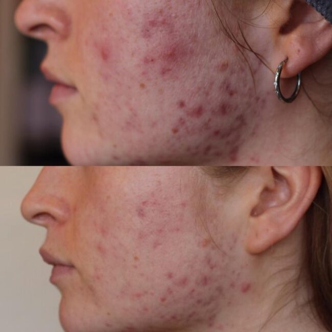 Dermapen-2