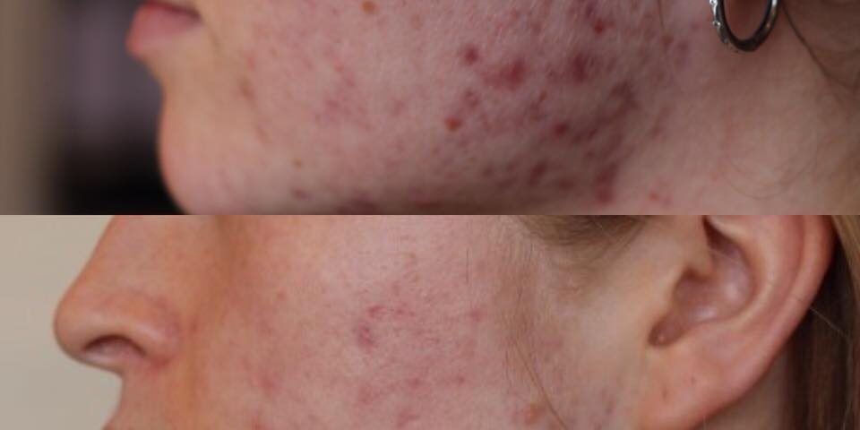 Dermapen-2