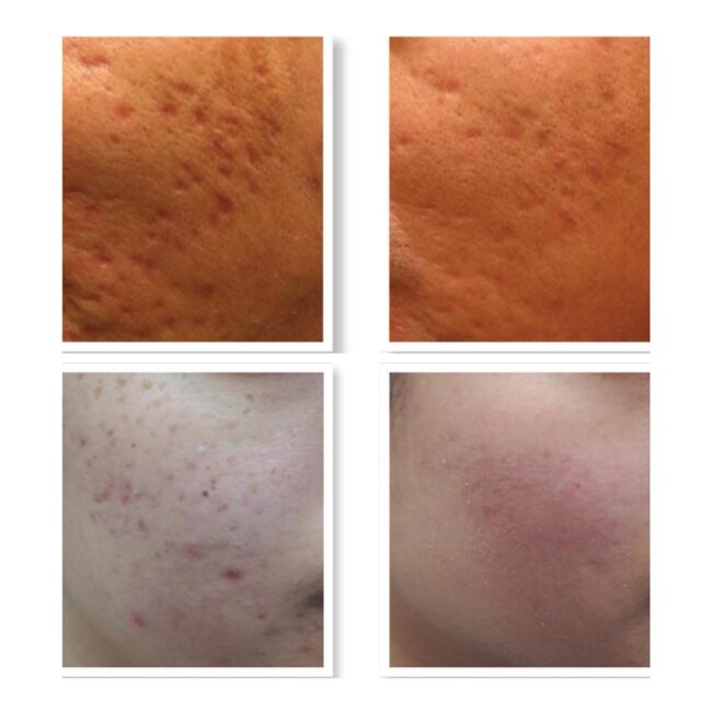 Dermapen