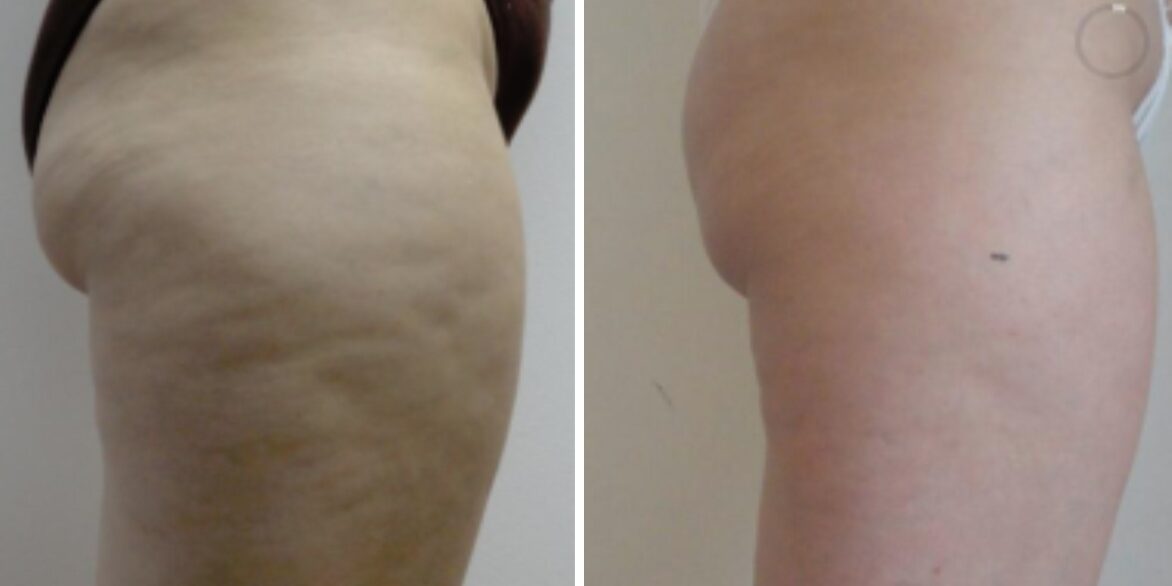 cellulite1