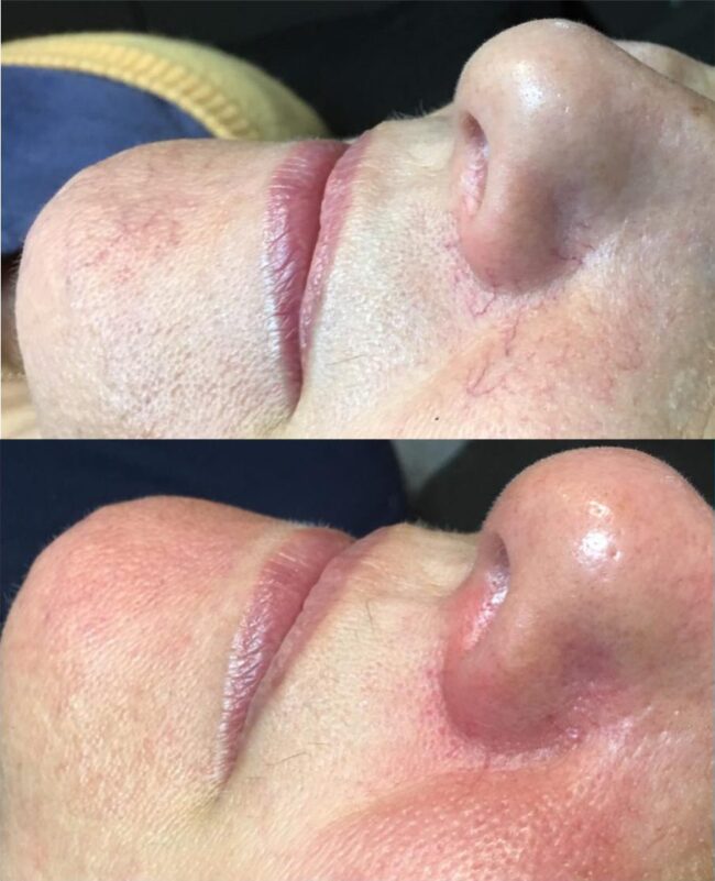 iplfacial
