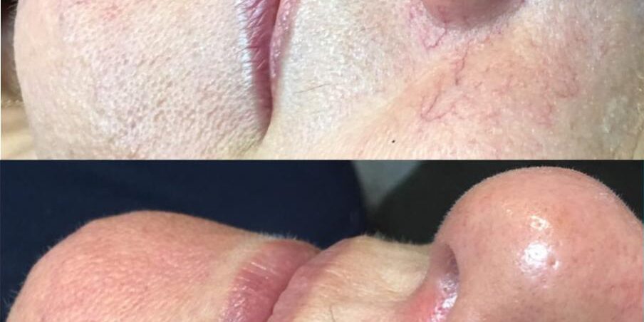 iplfacial