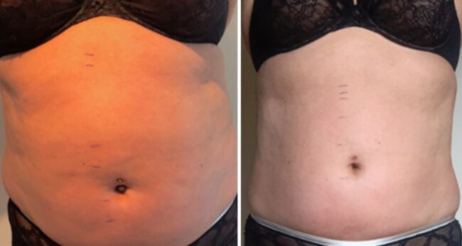 tummy2